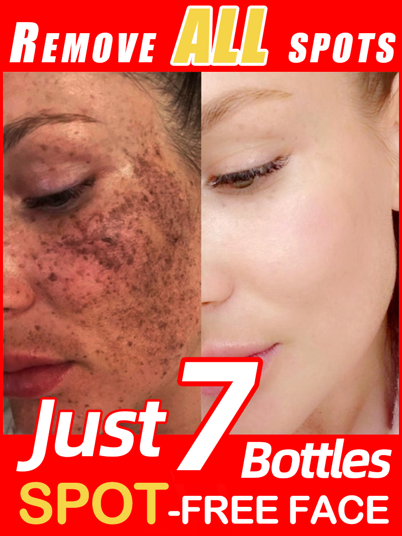 Lighten Freckles Melasma, Faci - Ultra Luxury Skincare recension och pris